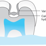Base Linear And Varnish Application of varnish in a tooth