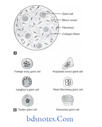 Benign and malignant tumors of Oral cavity Giant cell