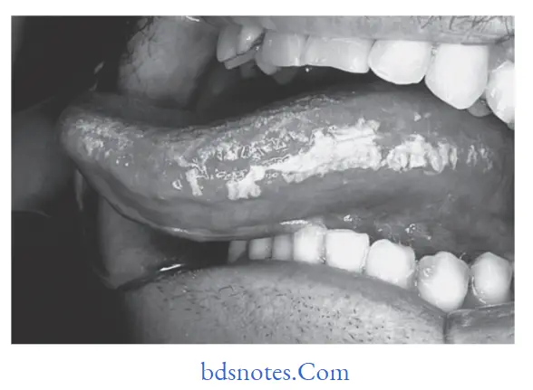 Benign and malignant tumors of Oral cavity Hairy leukoplakia