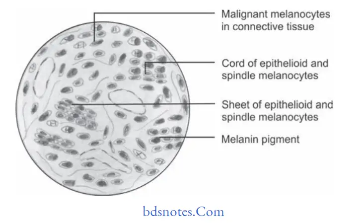 Benign and malignant tumors of Oral cavity Malignant melanoma