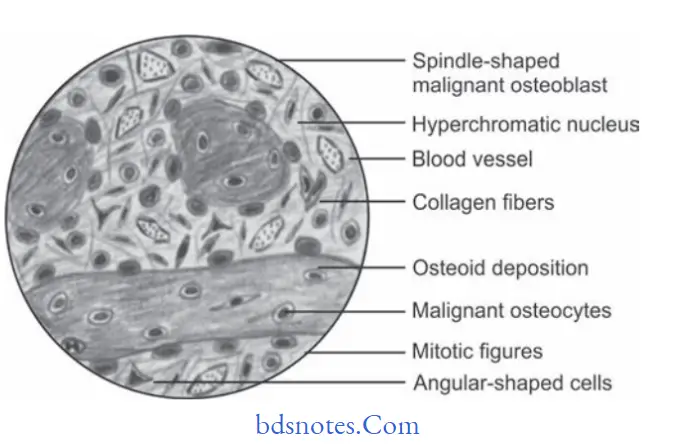 Benign and malignant tumors of Oral cavity Osteosarcoma