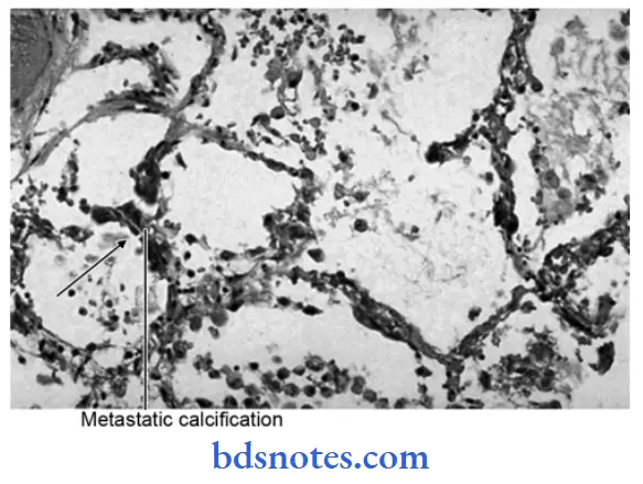 Cell Injury And Cellular Adaptations Metastatic Calcification