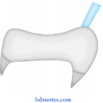 Dental Casting And Metal Fabrication Procedures Back pressure Porosity