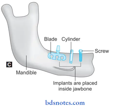 Dental Implant Materials based On Design Of Implant Endosseous Implant