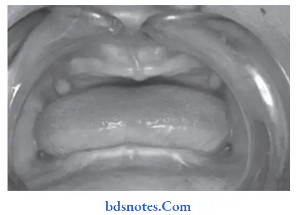 Developmental Disturbances of Oral and Para oral Structures Anodontia