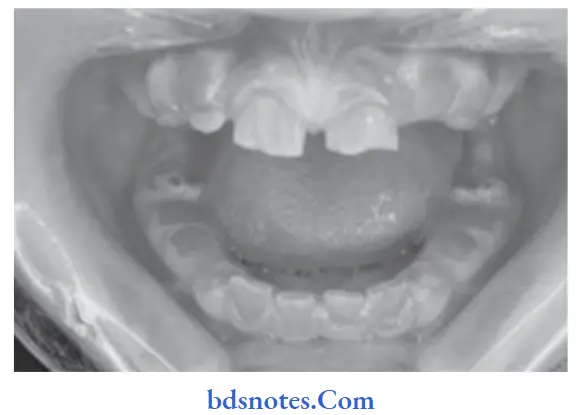 Developmental Disturbances of Oral and Para oral Structures Dentinogenesis imperfecta