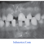 Developmental Disturbances of Oral and Para oral Structures Microdontia