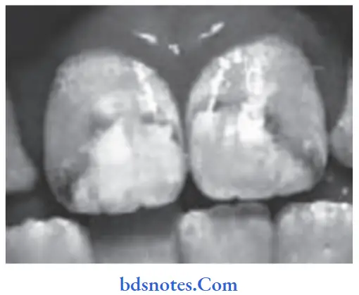 Developmental Disturbances of Oral and Para oral Structures Mottled enamel