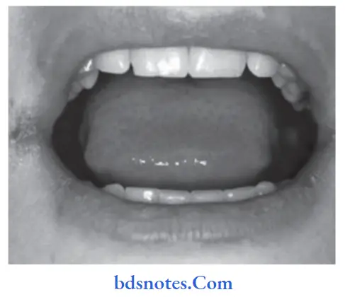 Developmental Disturbances of Oral and Para oral Structures Perleche