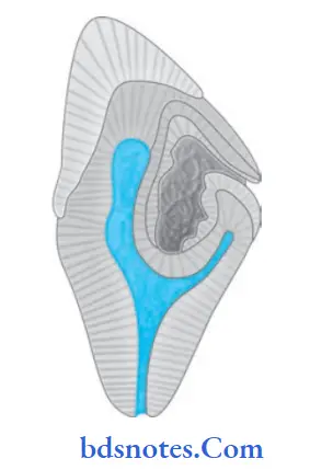Developmental Disturbances of Oral and Para oral Structures Radicular dens invaginatus