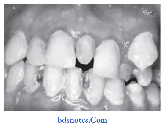 Developmental Disturbances of Oral and Para oral Structures Supernumerary teeth