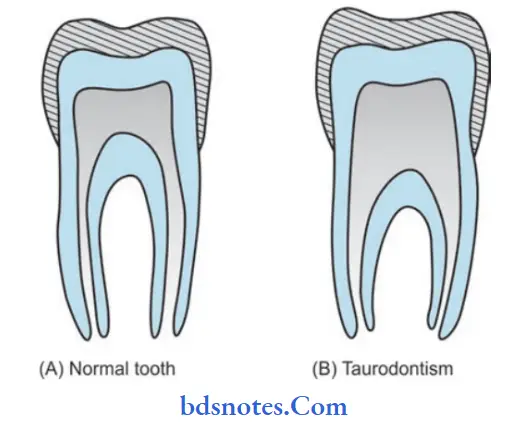 Developmental Disturbances of Oral and Para oral Structures Taurodontism