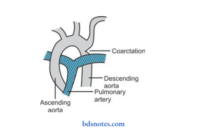 Diseases of Cardiovascular System Coarctation of aorta