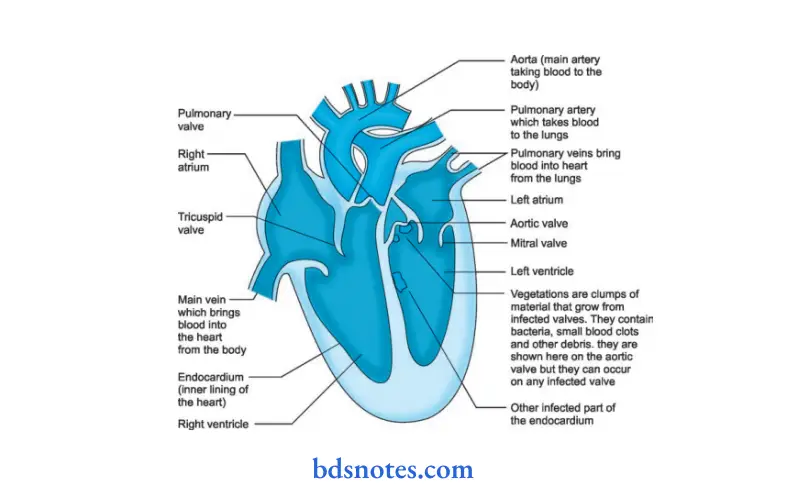 Diseases of Cardiovascular System Subacute bacterial endocarditis heart