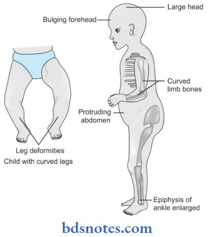 Environmental And Nutritional Diseases Rickets