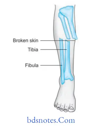 Fractures of Bone Compound fracture
