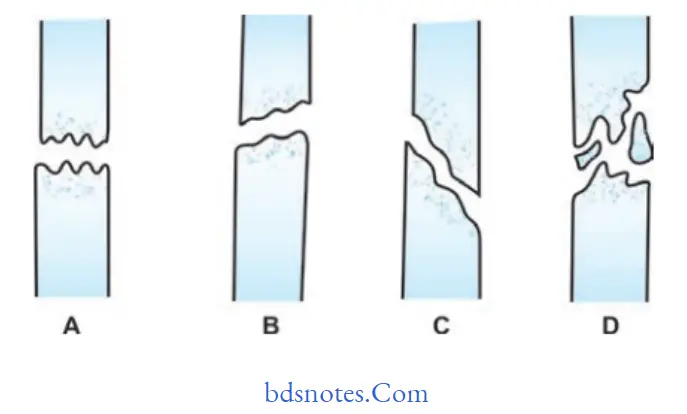 Fractures of Bone Types of fracture; (A) Transverse fracture; (B) Oblique fracture; (C) Spiral fracture; (D) Comminuted fracture
