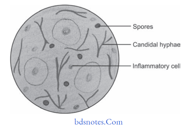 Fungal Infections of Oral Cavity Candida albicans