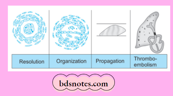 Hemodynamic Changes Fate Of Thrombosis
