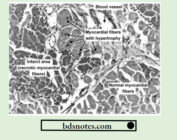 Hemodynamic Changes-Infarct