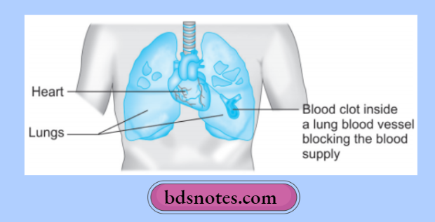 Hemodynamic Changes Pulmonary Embolism