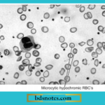 Iron Deficiency Anemia Blood Film