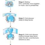 Lymphatics and Lymph Node Enlargement Tubercular lymphadenitis