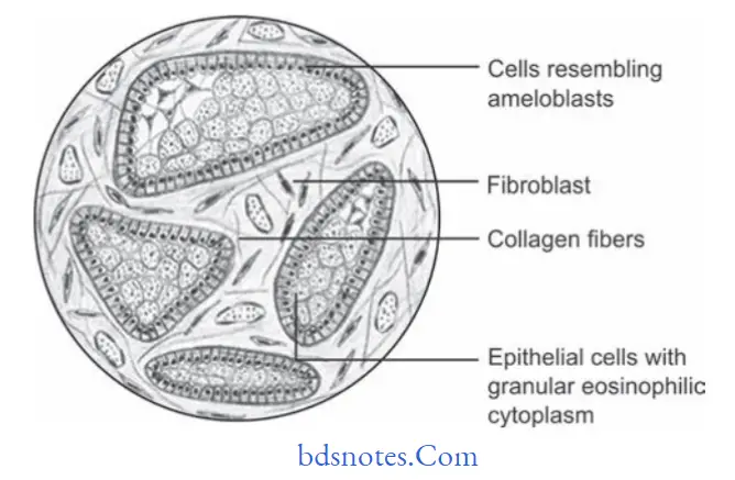 Odontogenic tumors Granular cell ameloblastoma