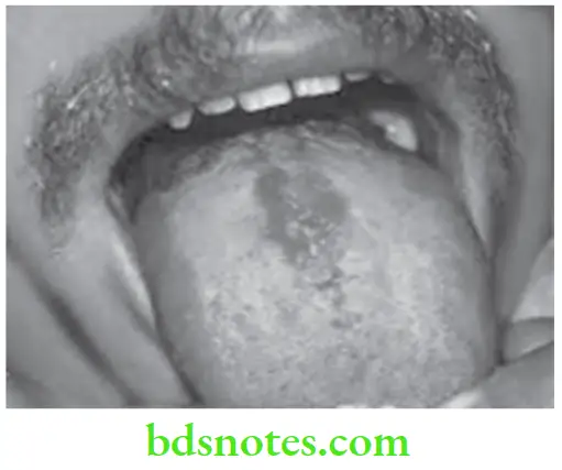 Oral Medcine Median Diseases Of Tongue Rhomboid Glossitis