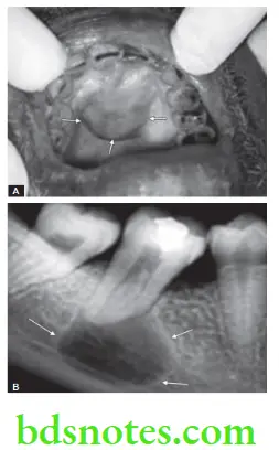Oral Medicine Cysts Of Jaw Periapical Cyst