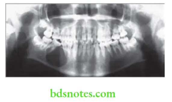 Oral Medicine Cysts Of Jaw Primordial Cyst