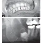 Oral Medicine Dentigerous Cyst Cysts Of Jaw