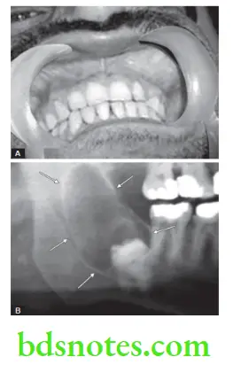 Oral Medicine Dentigerous Cyst Cysts Of Jaw
