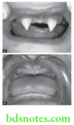 Oral Medicine Developmental Disorders Of Teeth And Jaw Anodontia