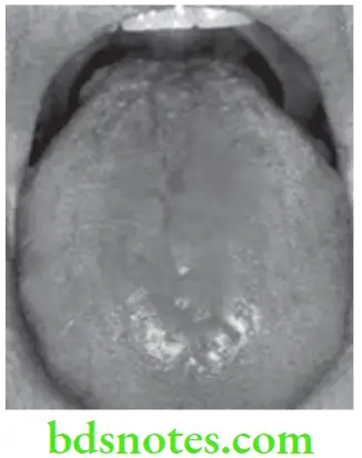 Oral Medicine Diseases Of Tongue Bold Tongue