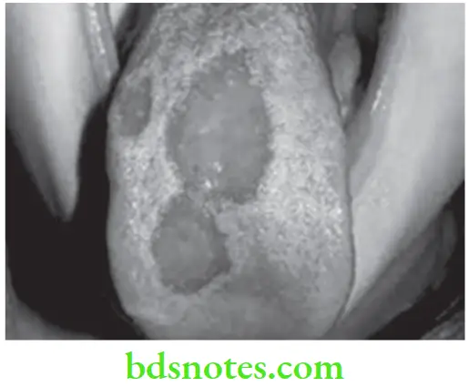 Oral Medicine Diseases Of Tongue Geographic Tongue