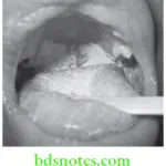 Oral Medicine Fungal Infections Oral Candidiasis