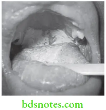 Oral Medicine Fungal Infections Oral Candidiasis