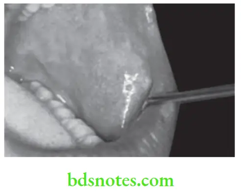 Oral Medicine Keratotic And Non-Keratotic White Lesions Fordyce's Spots