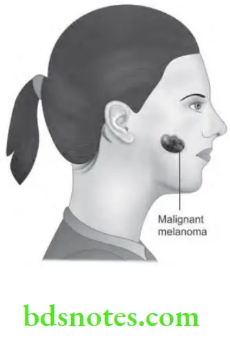 Oral Medicine Malignant Tumors Of Jaws Malignant Melanoma