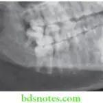 Oral Medicine Miscellaneous X-ray For Osteoradionecrosis