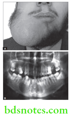 Oral Medicine Odontogenic Tumors Ameloblastoma