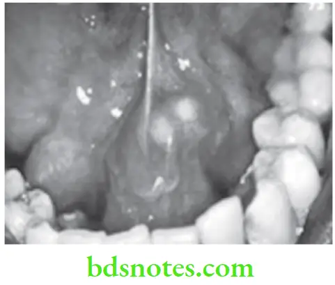 Oral Medicine Salivary Gland Disorders Sialolithiasis