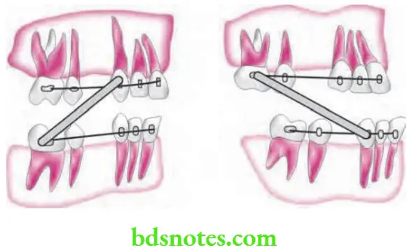 Orthodontics Anchorage In Orthodontics Intermaxillary anchorage 1