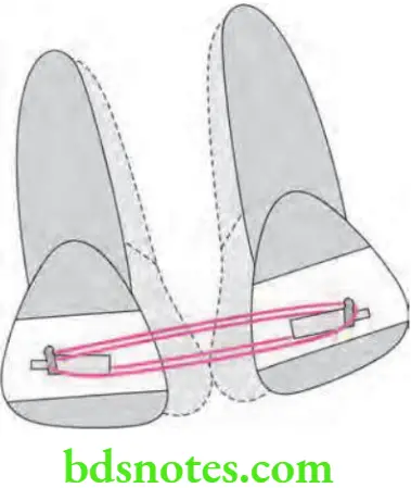 Orthodontics Anchorage In Orthodontics Reciprocal anchorage