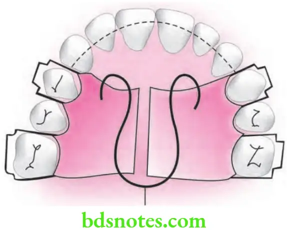 Orthodontics Arch Expansion As Method Of Gaining Space Coffin spring