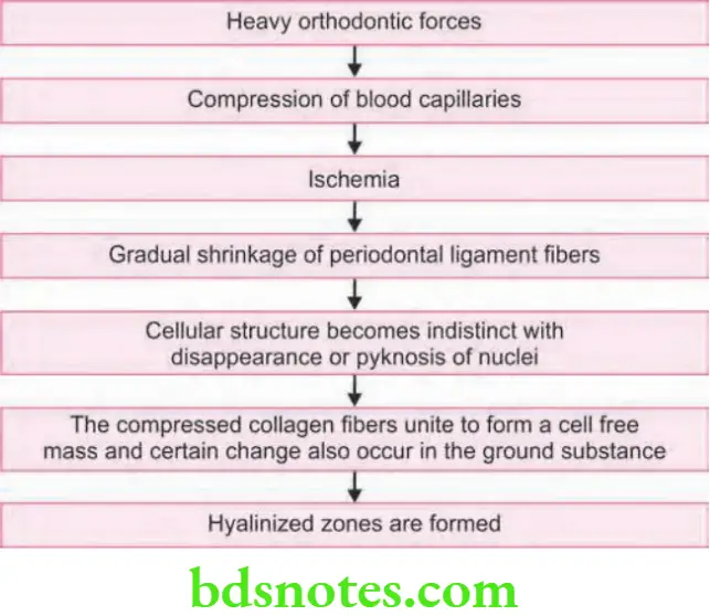 Orthodontics Biology Of Tooth Movement Summary of Hyalinization