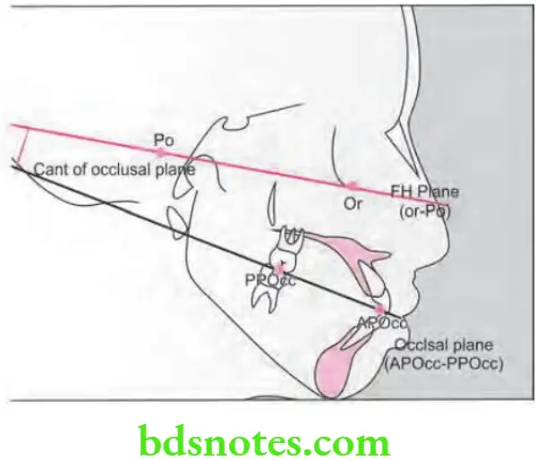 Orthodontics Cephalometrics Cant of occlusal plane