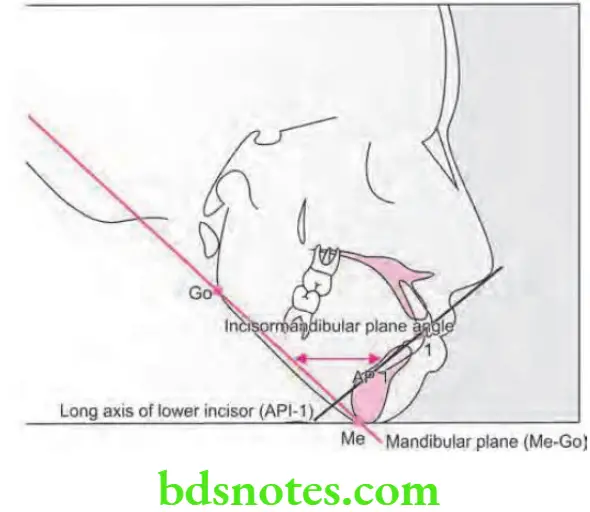 Orthodontics Cephalometrics Incisor mandibular plane angle