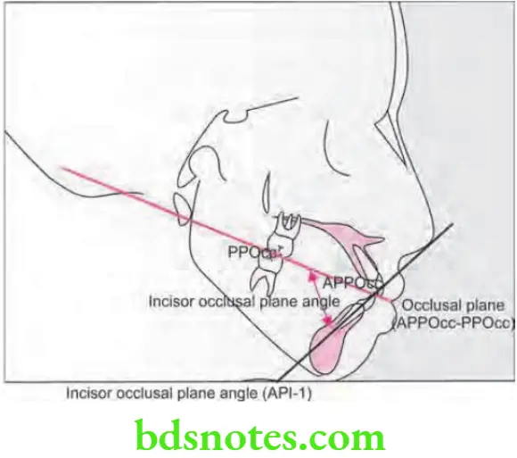 Orthodontics Cephalometrics Incisor occlusal plane angle